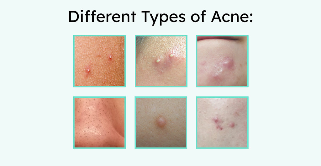 Different Types Of Acne