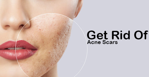 How to get rid of acne scars, according to the experts