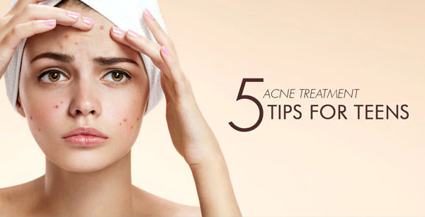 5 Acne Treatment Tips for Teens!