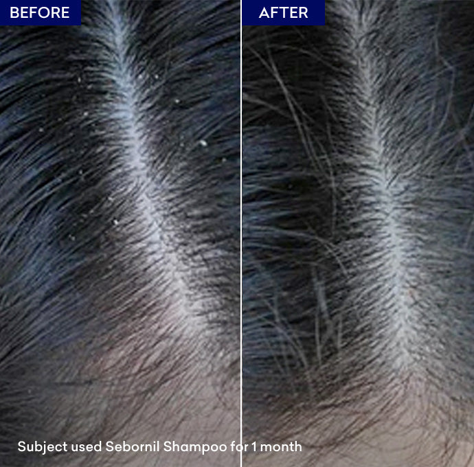 Show dandruff shampoo
