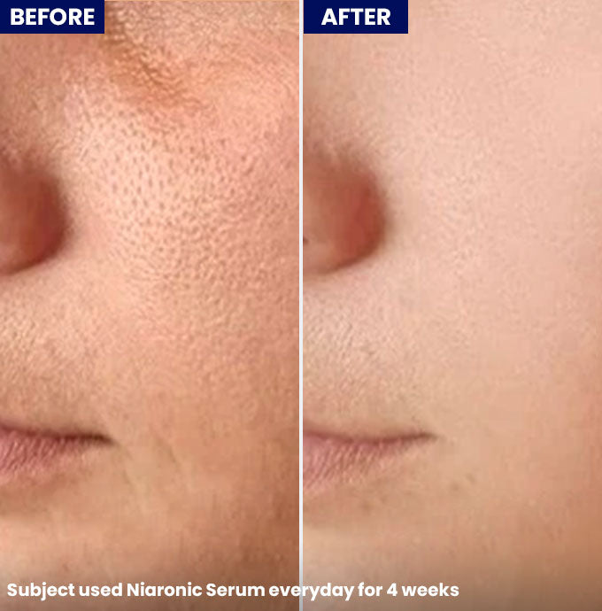 Show NiaRonic Serum (Pore Minimizing)