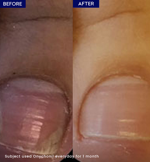 Show nail fungus remover