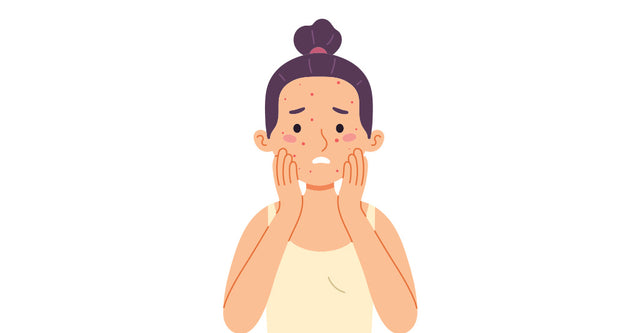 The Agoncy Of Adult Acne
