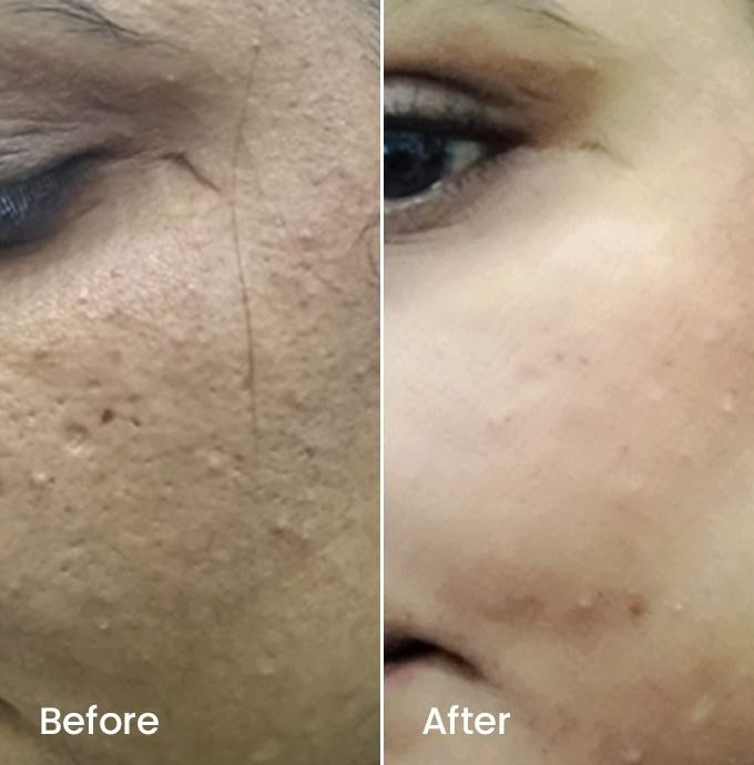 Huma before and after