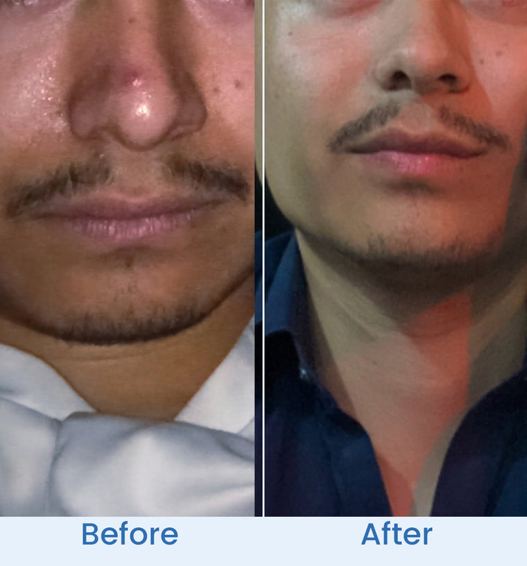 Haris before and after