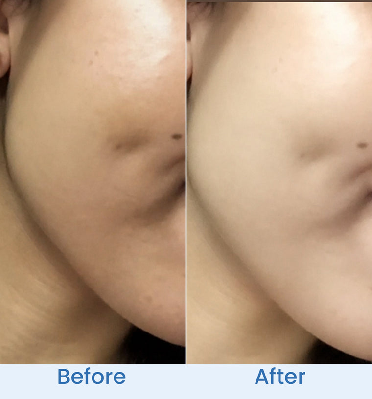 Anila before and after