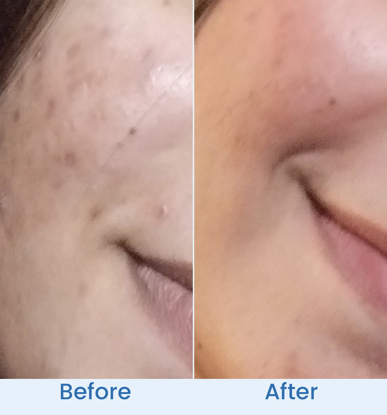 Alia before and after