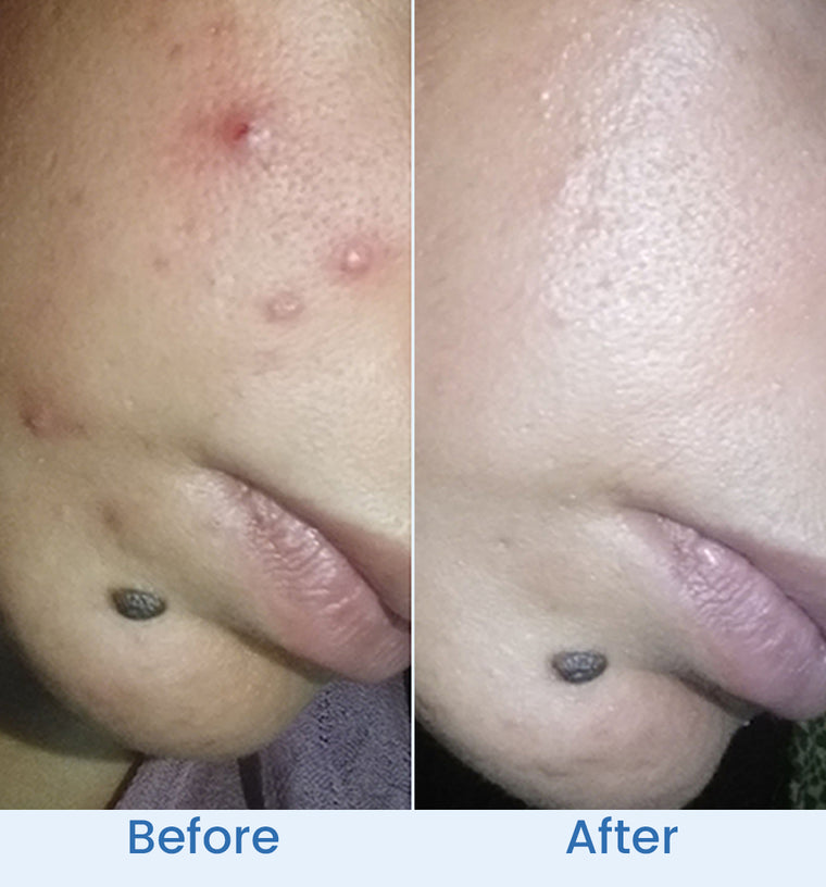 Bisma before and after