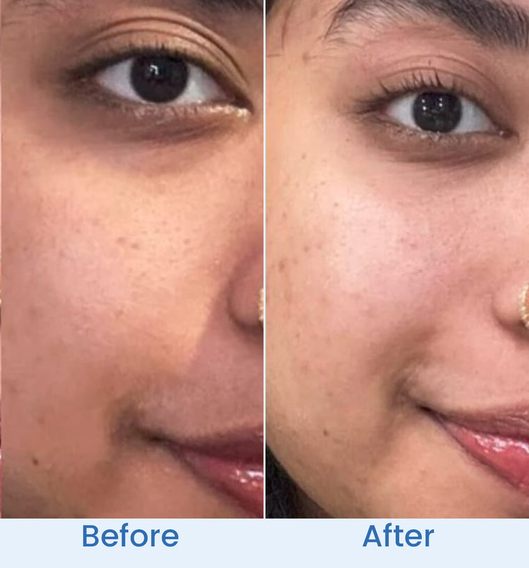 Zara before and after