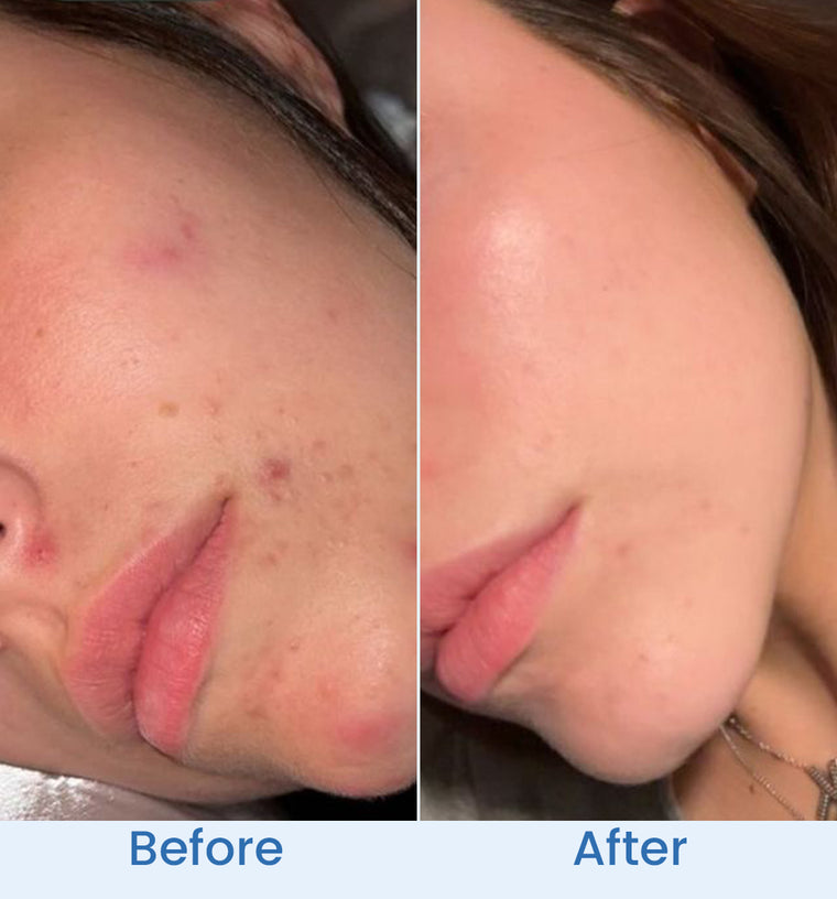 Rabia before and after