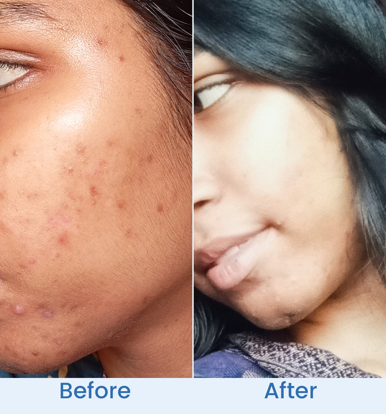 Anila before and after